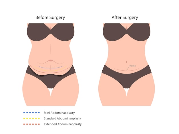 Vetor abdominoplastia cirurgia de abdominoplastia perda de gordura da pele