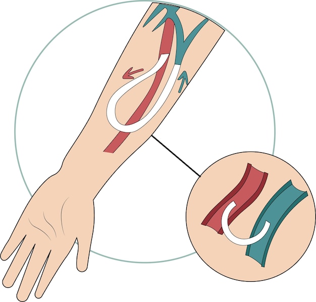 Vetor acesso vascular