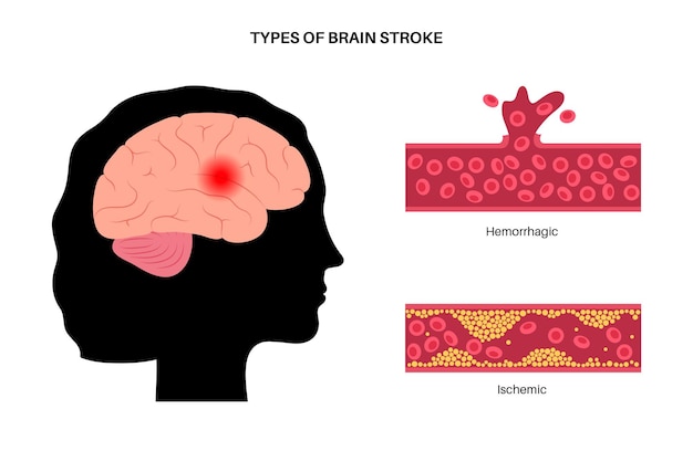 Vetor acidente vascular cerebral isêmico e hemorrágico