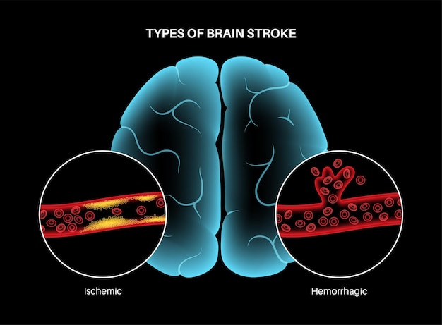 Acidente vascular cerebral isêmico e hemorrágico