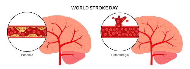 Acidente vascular cerebral isêmico e hemorrágico