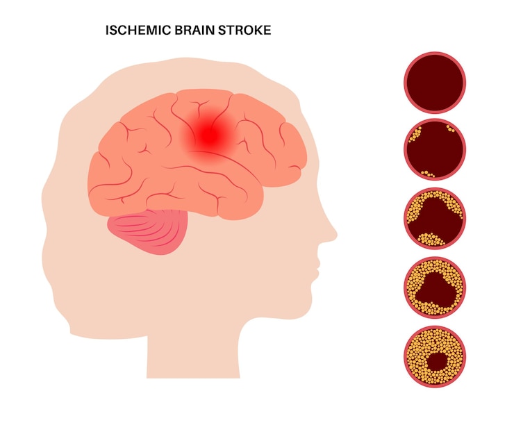 Vetor acidente vascular cerebral isêmico