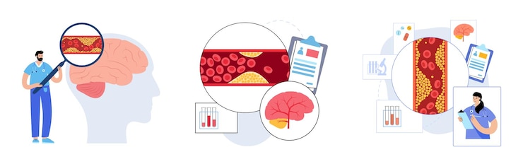 Vetor acidente vascular cerebral isquêmico arteriosclerose infarto tia cva conceito colesterol no vaso sanguíneo