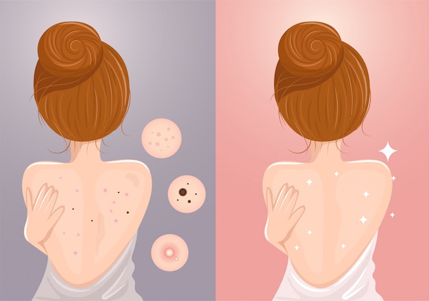 Vetor acne causada nas costas