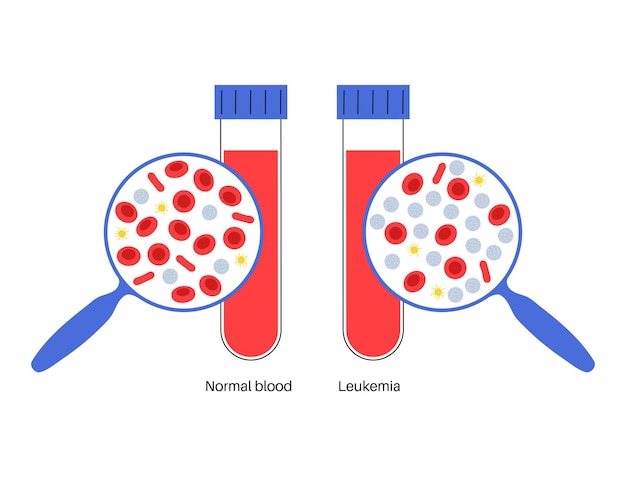 Vetor amostra com doença leucêmica e sangue normal. conceito de câncer de sangue. células do sangue humano