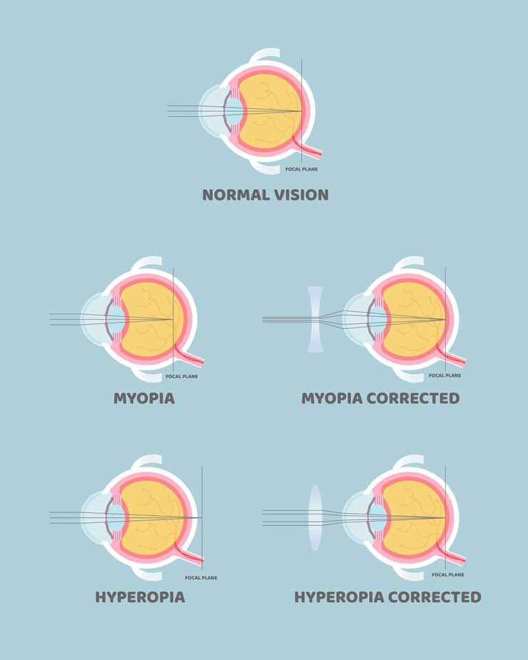 Vetor anatomia do globo ocular míope míope míope hipermetropia e conceito de miopia