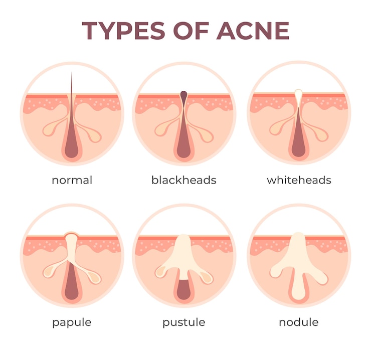 Vetor anatomia dos tipos de acne. doenças da espinha visão seccional cravo, cística e espinha. estrutura do infográfico de vetor de infecção de pele e poros. comedões abertos e fechados. doença médica