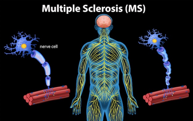 Anatomia humana da esclerose múltipla