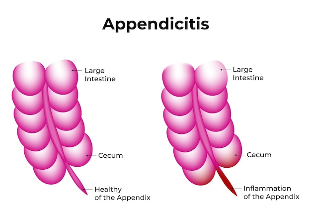 Apendicite intestino grosso cecum saudável e inflamação do vetor do apêndice ilustração