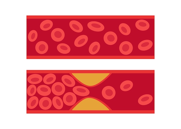 Artéria normal e bloqueada por colesterol coágulo sanguíneo trombo placa trombose venosa fluxo vascular