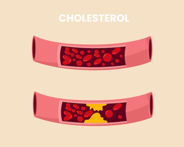 Artéria normal e obstruída pelo colesterol circulação bloqueada no vaso sanguíneo que causa ataque cardíaco