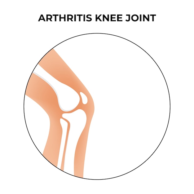 Vetor artrite da articulação do joelho anatomia óssea humana ilustração de vetor plano artrite da articulação do joelho osso humano