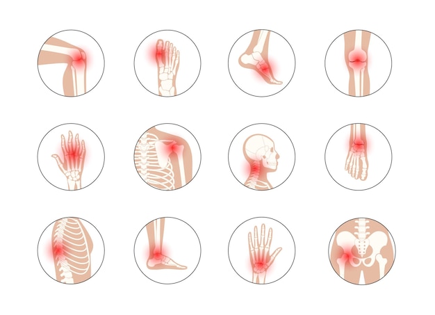 Vetor artrite reumatóide, dor, conceito de doença óssea.