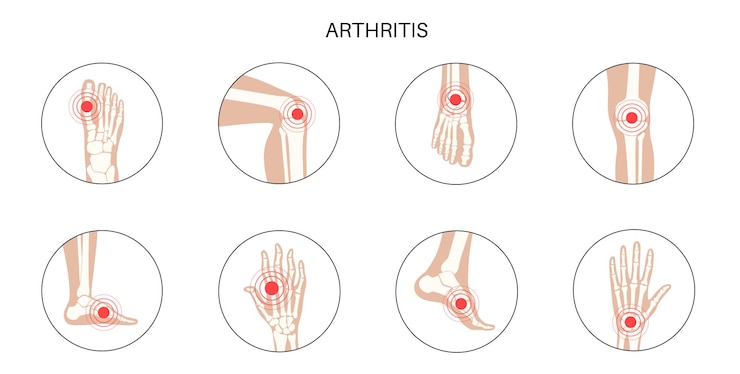 Vetor artrite reumatóide, inflamação, conceito de doença óssea.