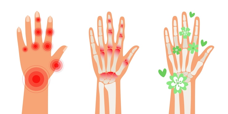 Vetor artrite reumatoide mãos dor no corpo humano artrite doença óssea cartaz médico ilustração do vetor da artrite do dedo