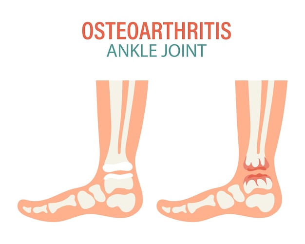 Vetor artrite reumatóide osteoartrite das articulações do tornozelo humano conceito médico infográfico pôster