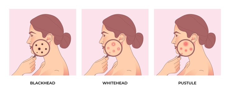 Vetor as mulheres enfrentam diferentes tipos de acne, espinhas, poros da pele, cravos, espinhas. tratamento de acne.