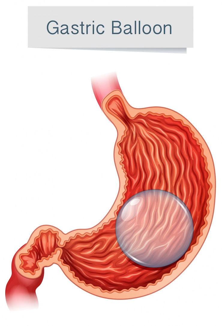 Vetor balão gástrico de vector médico de anatomia