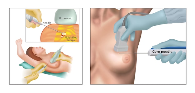 Vetor biópsia mamária