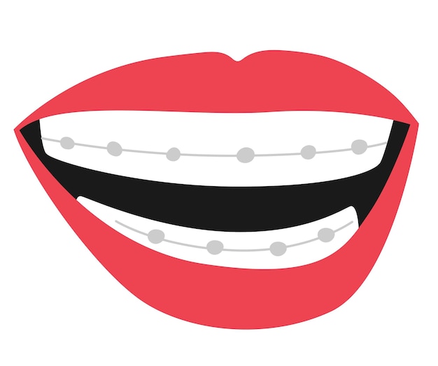 Vetor boca com aparelho apresenta um belo sorriso adornado com braquetes de metal e fios que endireitam os dentes