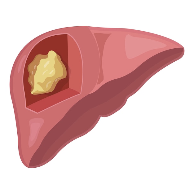 Vetor câncer de fígado isolado no fundo branco