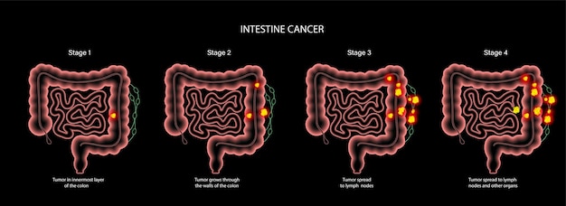 Vetor câncer de intestino 3d