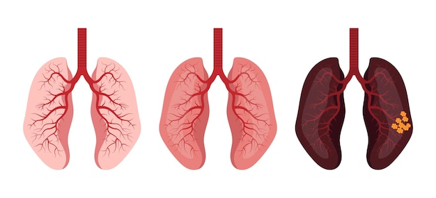 Vetor câncer de pulmão de células cancerosas normais a doentes conceito de saúde
