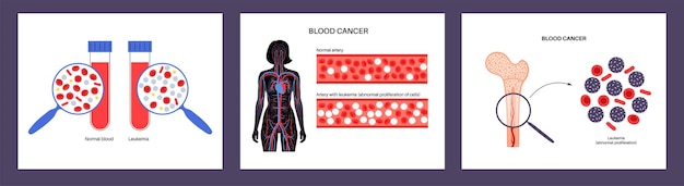 Vetor câncer de sangue leucemia