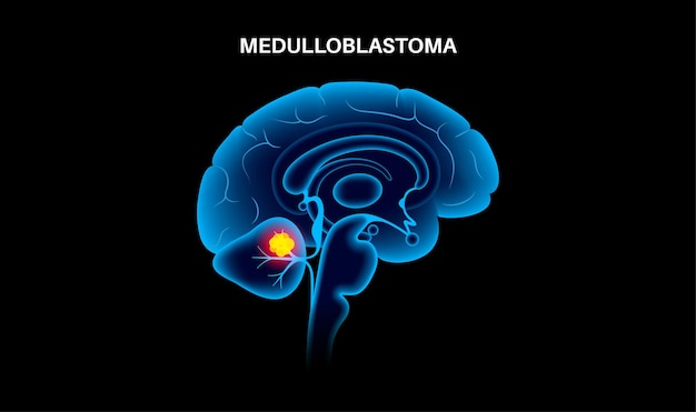 Câncer do cérebro de meduloblastoma