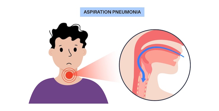 Vetor cartaz de pneumonia por aspiração