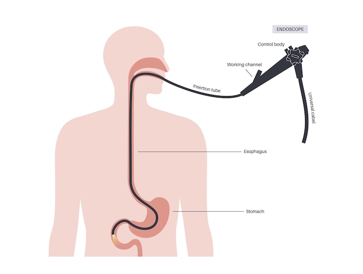Vetor cartaz médico de esofagogastroduodenoscopia diagnóstico endoscópico procedimento minimamente invasivo visualização da orofaringe esôfago estômago e duodeno proximal gastroenterologia vetor plano