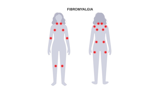 Vetor cartaz médico de fibromialgia