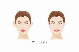 Vetor cirurgia de orelha (otoplastia) cirurgia plástica, remodelação de orelhas, cirurgia cosmética de orelha