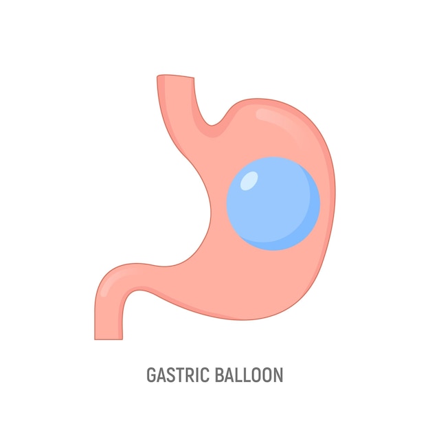 Cirurgia intragástrica de perda de peso de balão gástrico Ícone de vetor de operação de balão gástrico de estômago