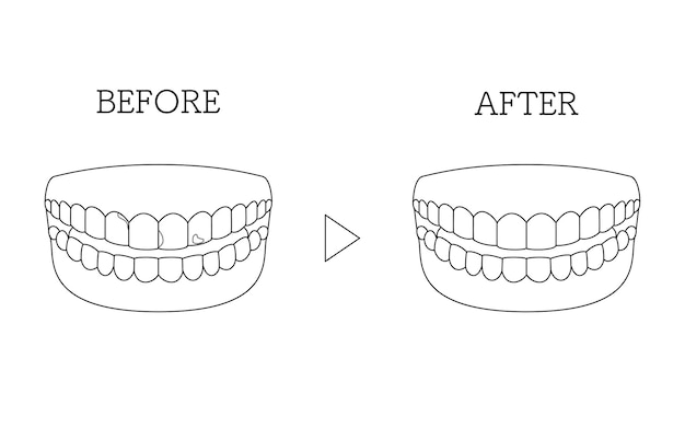 Vetor colagem direta de odontologia cosmética antes e depois da descoloração dos dentes