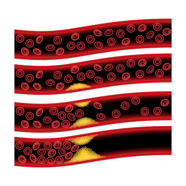 Colesterol e aterosclerose