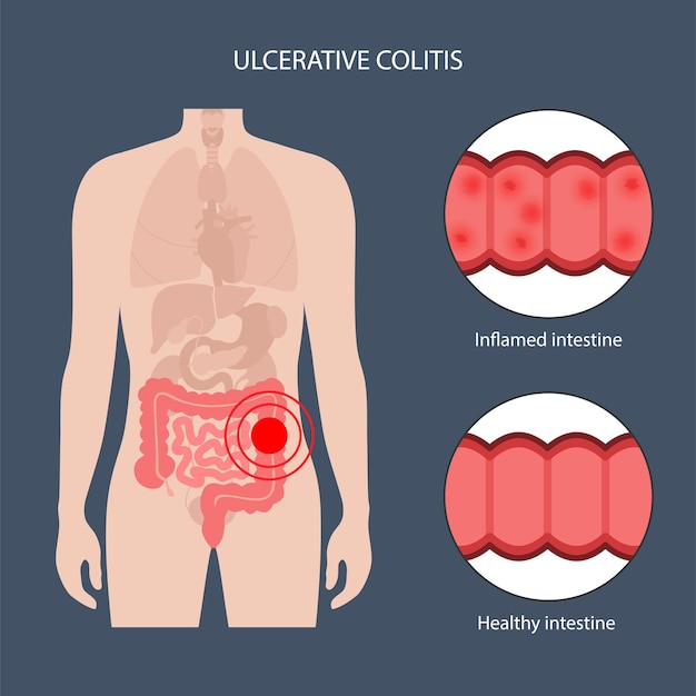 Colite ulcerosa intestinal