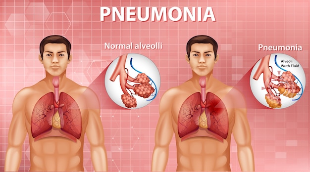 Comparação de alvéolos saudáveis e pneumonia