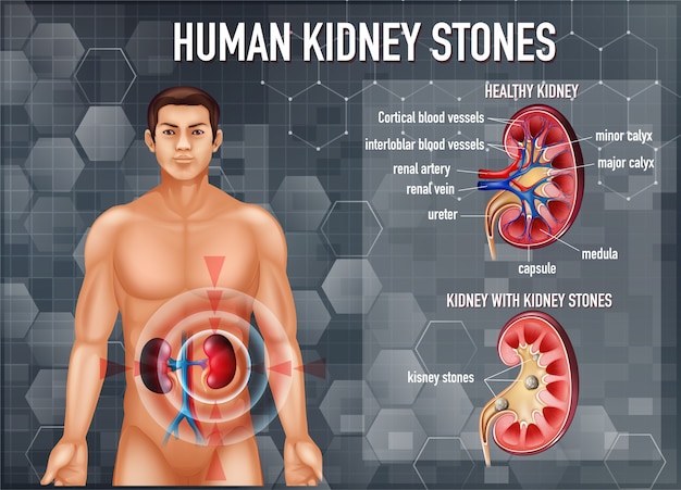Comparação de rim e rim saudáveis com pedras