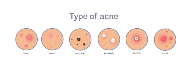 Conceito de acne. tipo de acne.papule,nodule,blackhead'whitehead,pustule,cystic.flat ilustração vetorial.