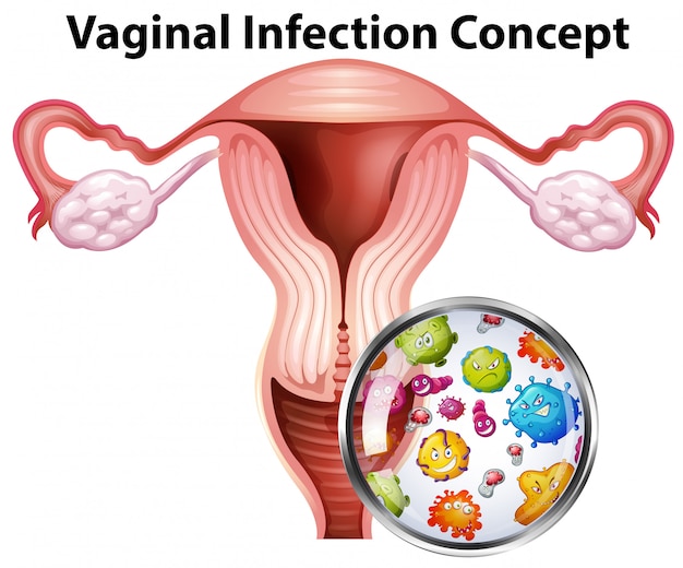 Conceito de bactérias de infecção vaginal | Vetor Premium