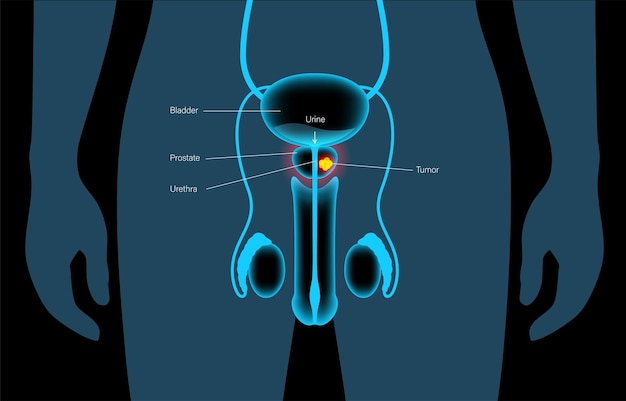 Vetor conceito de câncer de próstata