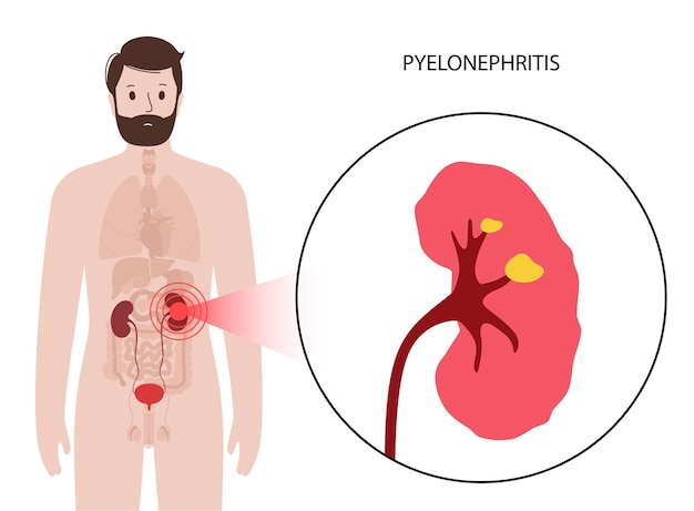 Conceito de doença renal