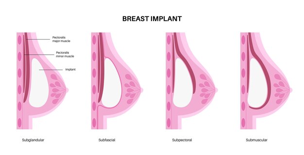 Vetor conceito de implante mamário