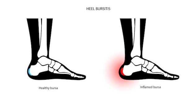 Conceito de inflamação de bursite