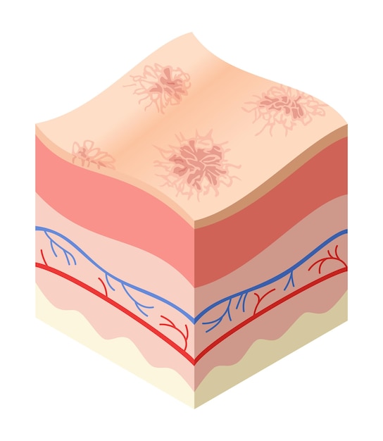 Conceito médico de cuidados com a pele problemas na seção transversal da estrutura de camadas horizontais da pele humana anatomia modelo ilustrativo camada insalubre da pele