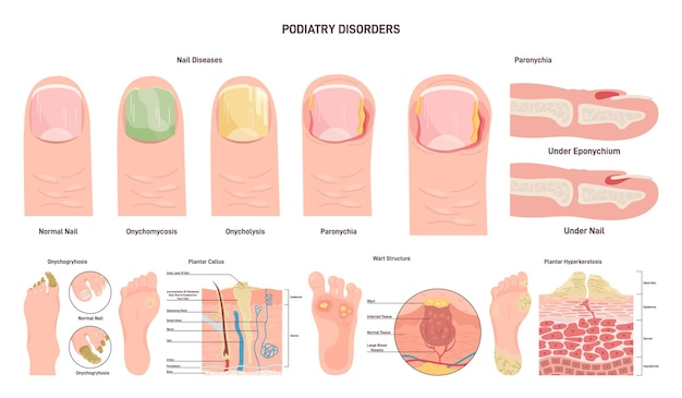 Vetor conjunto de doenças de podologia distúrbios de pés e unhas ou condição médica