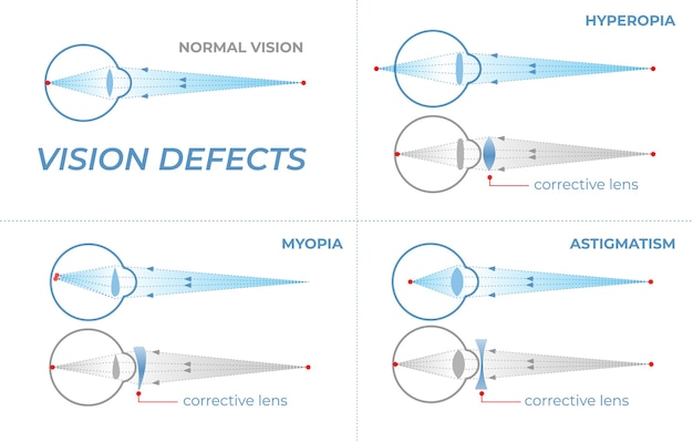 Defeitos de visão e sua correção com lentes intraoculares problemas de visão