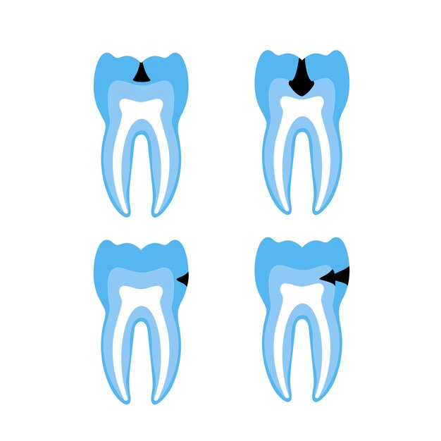 Dente com ilustração vetorial de cárie. cartaz médico da deterioração dos dentes. consultório odontológico, clínica odontológica