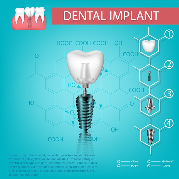 Dente realista vetorial elementos estruturais de um implante dentário infográfico para pôster médico